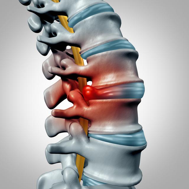 椎間関節性腰痛